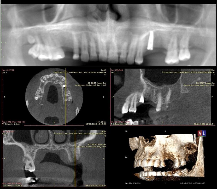 Figg. 1a, 1b - Situazione iniziale.