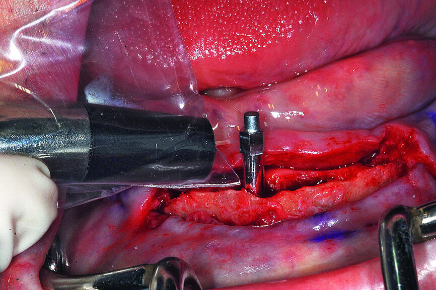 Fig. 17: Each of the four implants was measured for implant stability with the implant specific SmartPeg.