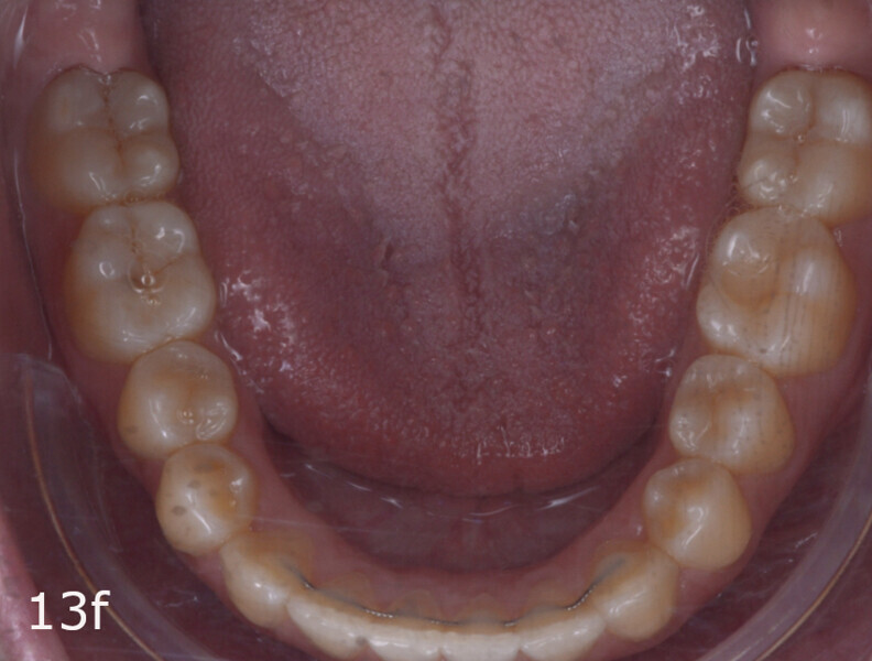 Figs. 13a–f: Final situation. The lack of overjet and overbite and the midlines had been improved and anterior and canine guidance achieved.