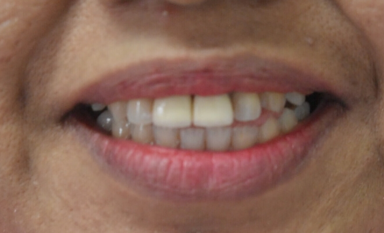 Screenshot from speech video during 6 years review. Tongue thrusting visible.