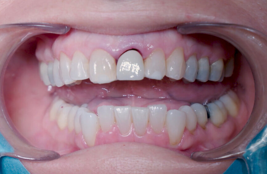 Fig. 23: Fitting assessment of provisional tooth shell.