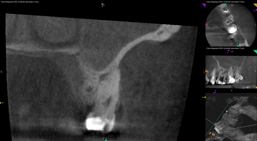 Fig. 8: Pre-op CBCT image showing a radiolucency above the MB root of the maxillary first molar. The radiolucency could be seen more clearly near the expected apical foramen of the MB2 canal.