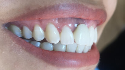 KATANA Zirconia UTML veneers and crown on zirconia implant cemented with PANAVIA Veneer LC