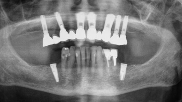 Les implants dentaires entraînent des risques de lésions nerveuses