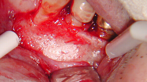 Predictable apical microsurgery: the incision and atraumatic flap elevation (Part 2) 