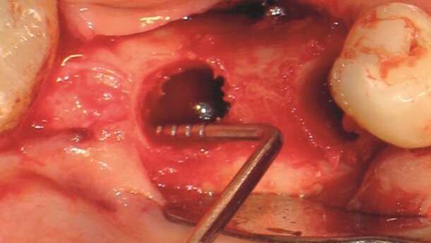 Ubytki w kościach szczęk i ich konsekwencje w implantologii stomatologicznej
