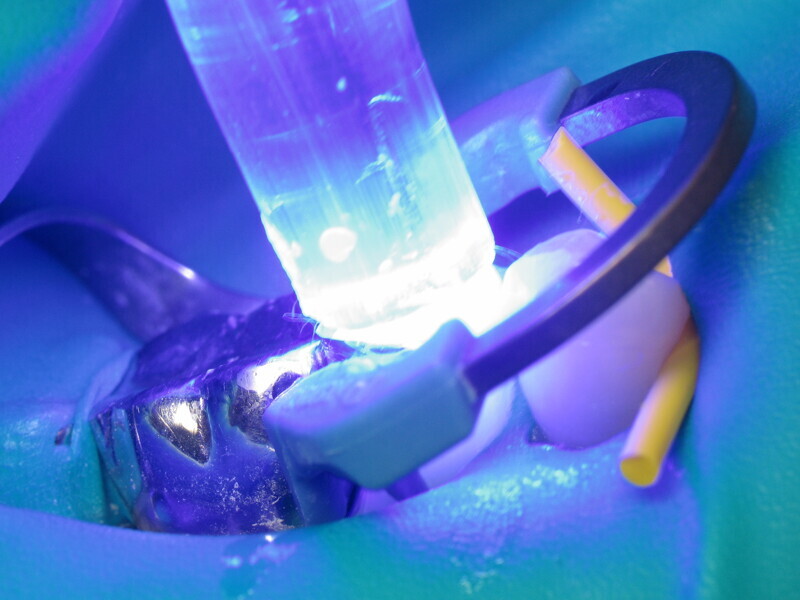 Fig. 11 : Photopolymérisation du composite.