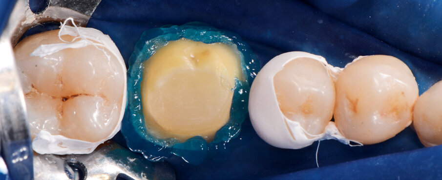 Fig. 6: Enamel etching prior to application of the adhesive.