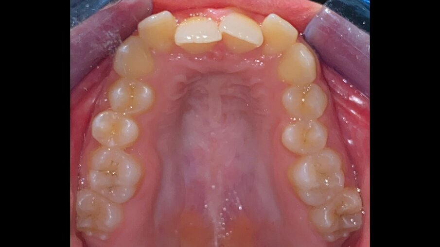 Fig. 8_Occlusale superiore pre-trattamento.