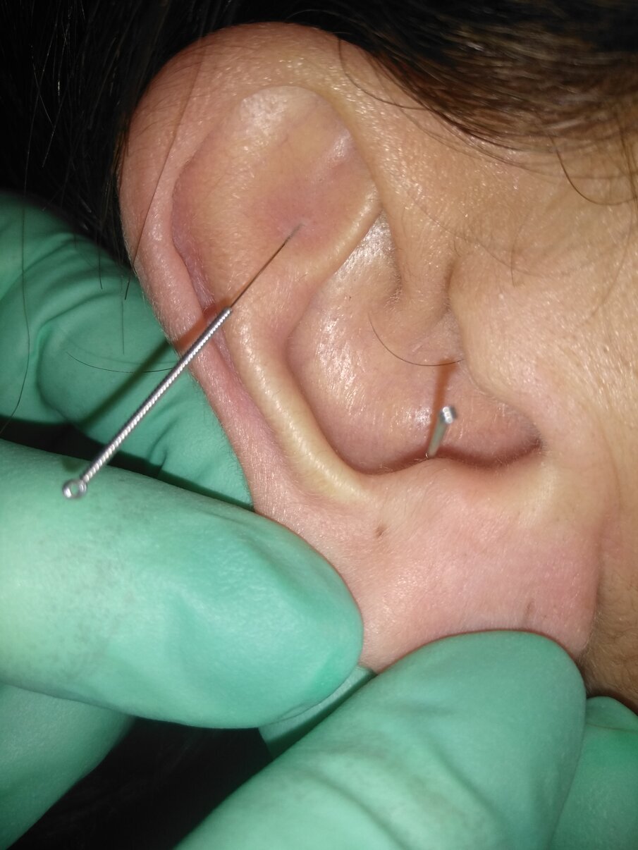 Fig. 1 - Inserimento degli aghi in regioni del padiglione auricolare