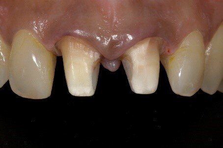 Fig 2: These types of preps can lead to increased flexibility of tooth structure thereby making it prone to breakage