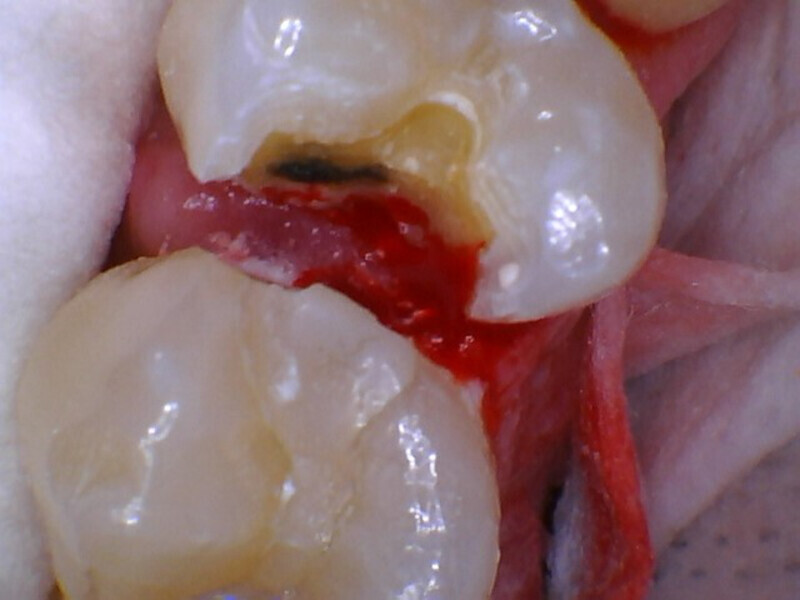 Fig. 3: Affected dentine evident over the pulpal area after excavation of the caries on the mesial and occlusal aspects.