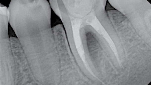 Praktické klinické faktory v reendodontické terapii