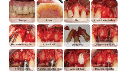 The most versatile barrier membrane for periodontal applications