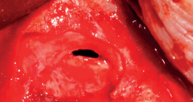 Complicaciones intraoperatorias