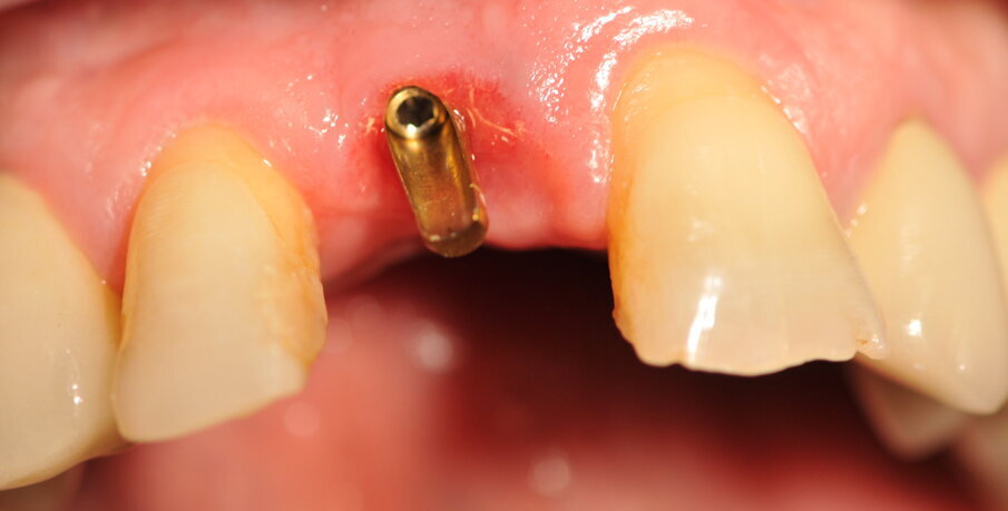 Fig. 5_Moncone Easy slim angolato, notare la quantità di tessuto cheratinizzato dopo condizionamento funzionale con corona provvisoria a pontic.