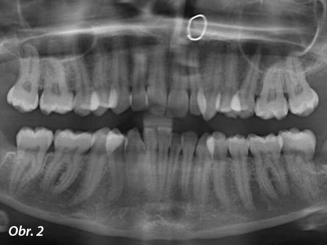 Vstupní RTG panoramatický snímek.