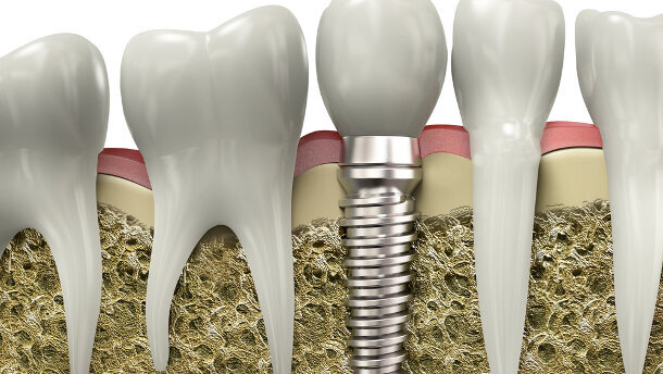 Implantate: Strom tötet Bakterien ab