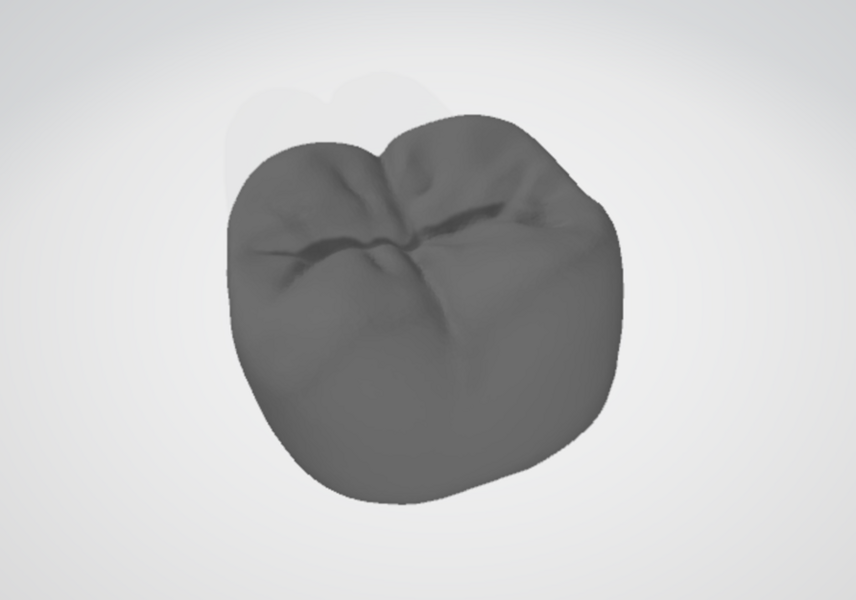 Fig. 7b: Verification of the finalised crown design STL model for tooth #37 prior to fabrication.