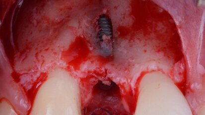 GBR in area estetica: gestione di un caso clinico dalle fasi chirurgiche a quelle protesiche