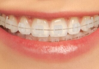 Clarity ADVANCED Ceramic Brackets: A revolutionary leap forward