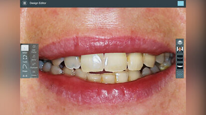 Fig. 2. Se simularon selectivamente los incisivos centrales ideales usando el software Smile Designer Pro. Fig. 2. Se simularon selectivamente los incisivos centrales ideales usando el software Smile Designer Pro.