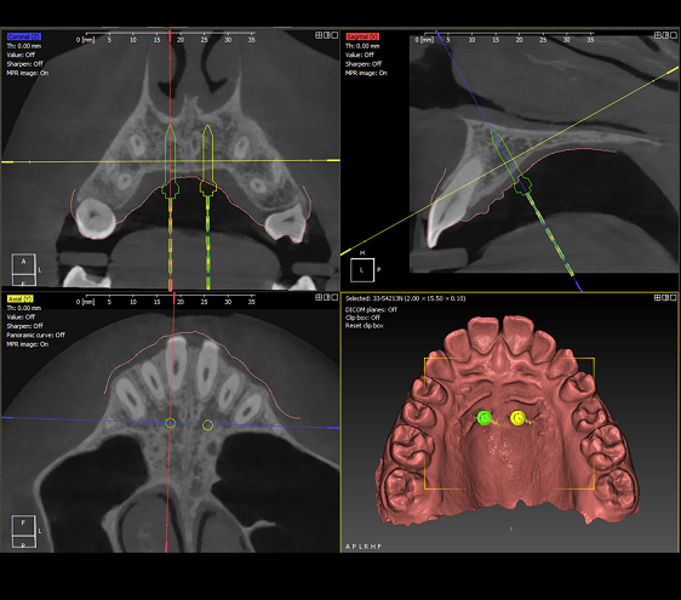 Fig. 5b: ...and fabrication of a 3D-printed guide for implantation. 