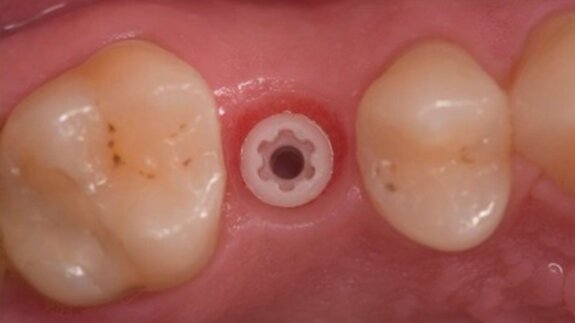 Impianti in Zirconia: una diversa risposta biologica al biofilm batterico