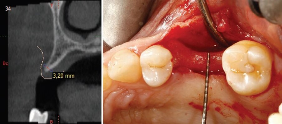 Fig. 3 - Progettazione impianto in cui si nota una particolare inclinazione implanto-protesica.