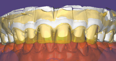 Zkratka po rychlé digitální dráze: Přesná reprodukce provizorních náhrad s IPS e.max Press® Multi