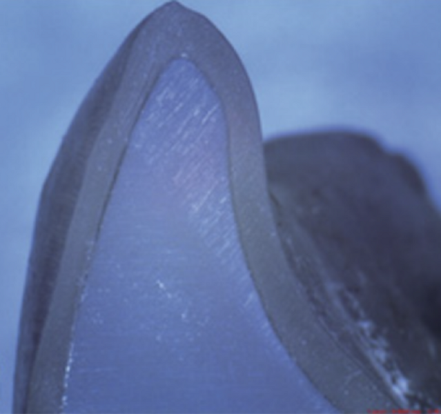 Fig. 13h: The Shape Memory Aligner shows good fit at the incisor.