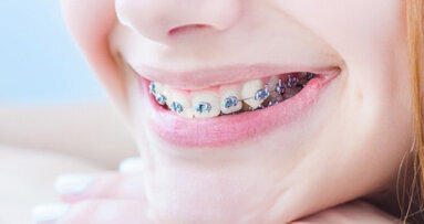 Gratiszahnspange: Einigung zwischen ÖZÄK und HV