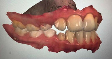 Utilizzo dello scanner intraorale in ortodonzia