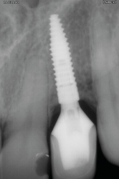 Fig. 31 : Contrôle à 2 ans