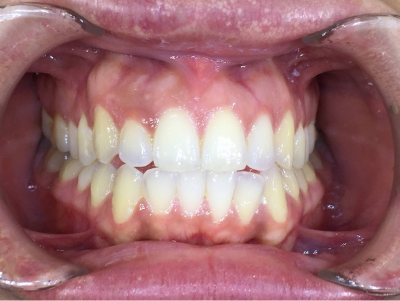 Fig. 30: Close-up view of the patient’s smile after aligner treatment.