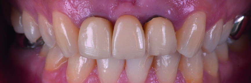 Fig. 2 : Vue intra-orale préopératoire. 