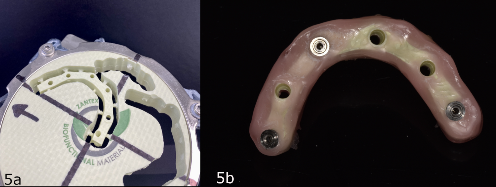 Figs. 5a et b : Disque de Zantex usiné et intrados de l’armature avec préposition de bagues de collage (laboratoire Newtech Antibes).