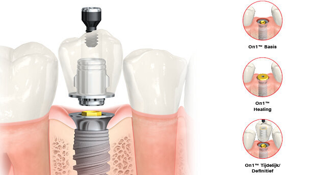On1™-concept: combineert het beste van twee werelden