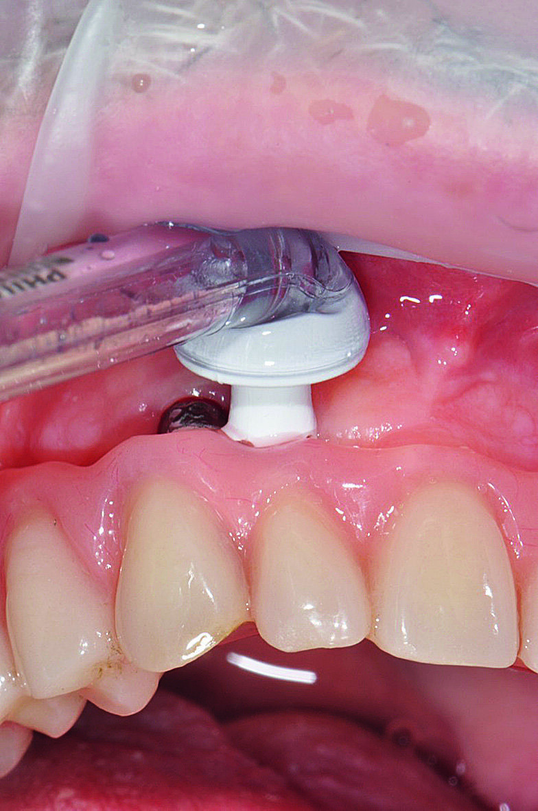 | Figs. 4a : Soins péri-implantaires à domicile avec AirFloss (Philips), 