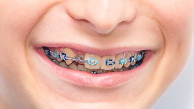 Σιδεράκια Do-it-Υourself