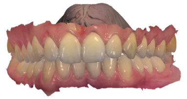 Malokluze I. třídy léčená pomocí F22 Aligners