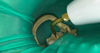 Consigli pratici per un trattamento endodontico affidabile