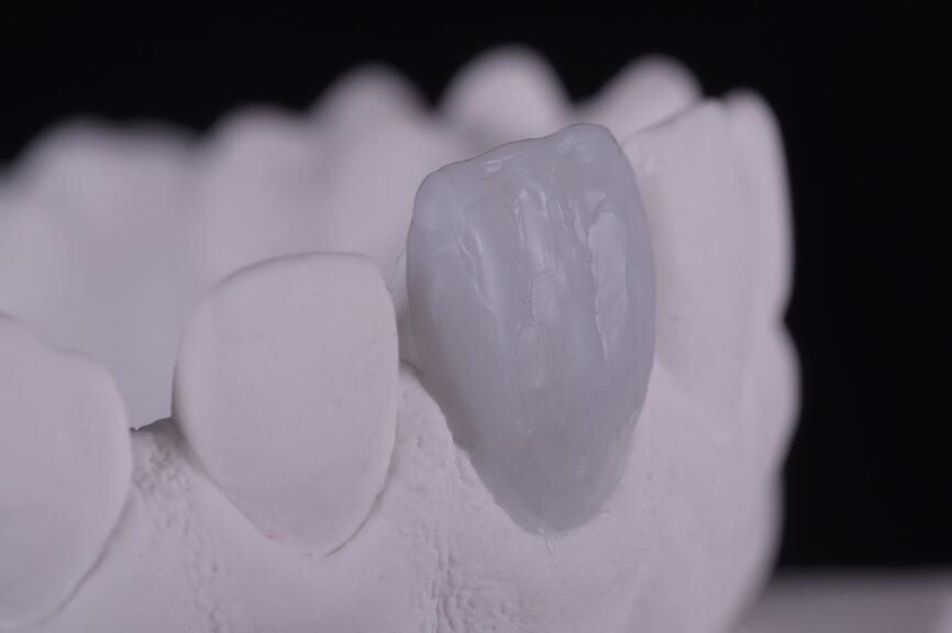 Fig. 25: Wax-up of the entire facial area, frontal and lateral views.