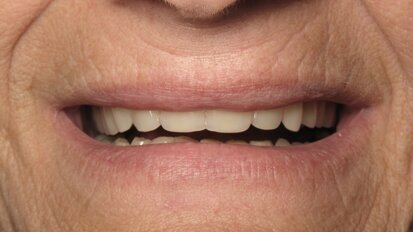 ¿Sabes cómo copiar y pegar una prótesis completa? (1)