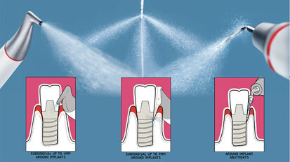 Implant Maintenance with Guided Biofilm Therapy
