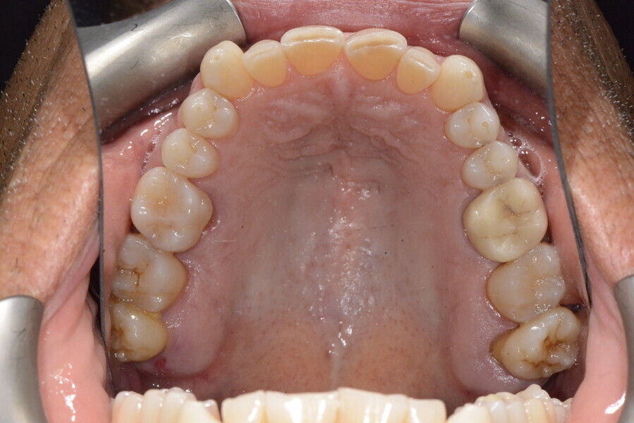 Figs. 12a & b: Maxillary and mandibular arches, occlusal views.