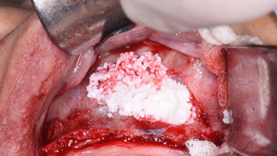 Obr. 5a, b: Umístění kolagenního náhradního kostního materiálu sticky bone do antrostomie na pravé straně (a) a hydratovaného heterologního náhradního
kostního materiálu do antrostomie na levé straně (b).