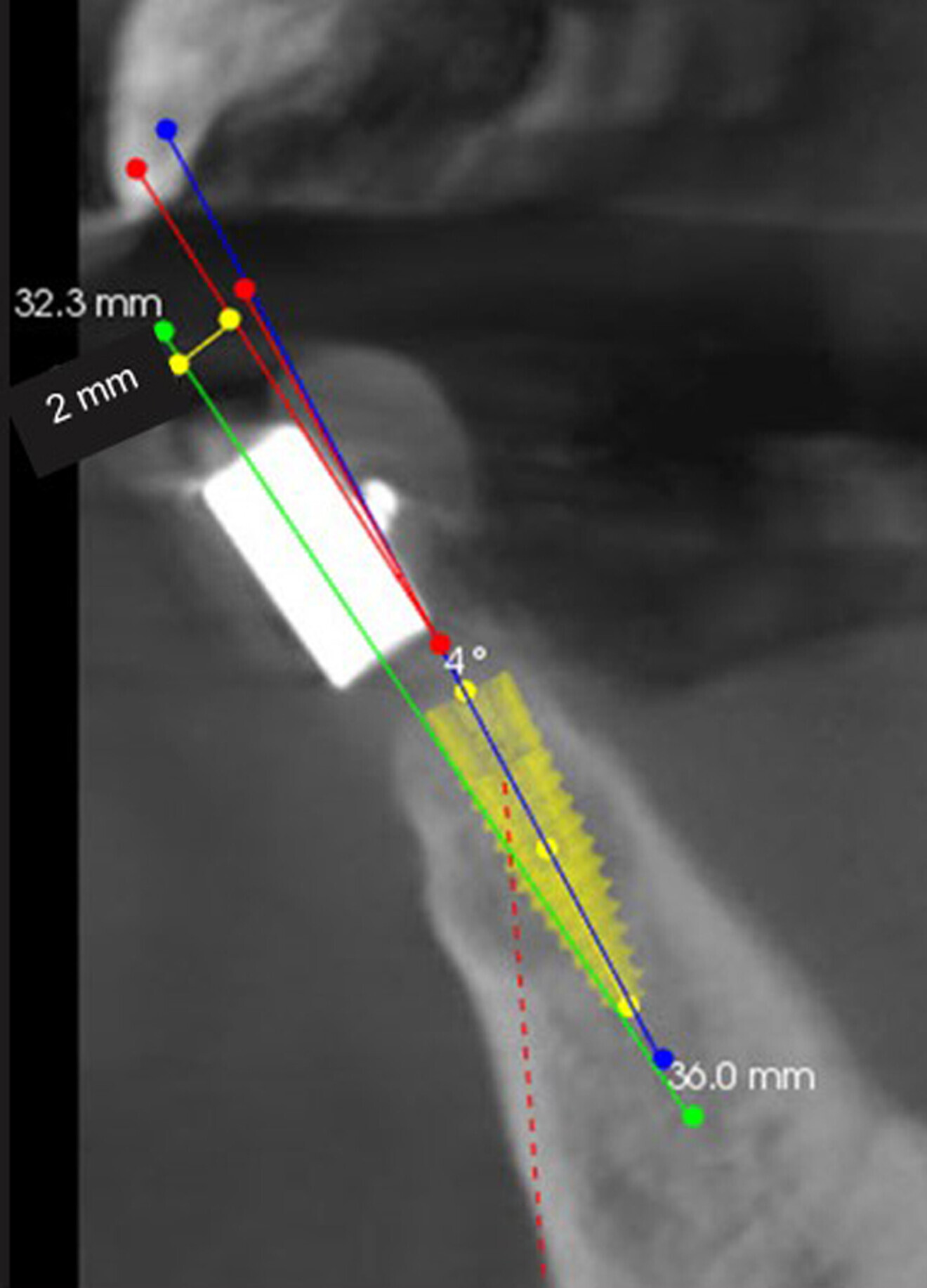  Fig. 10: Required angle correction of 6° (red line) between the planned implant axis (blue line) and the axis of the guide sleeve (green line).