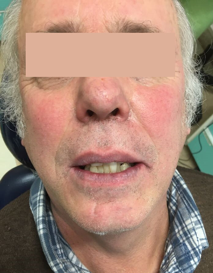 Fig. 10 - A tre giorni dall’intervento il paziente non presentava più alcun gonfiore. La tecnica appare efficace nel ridurre l’invasività chirurgica, richiedendo un lembo d’accesso ridotto rispetto l’approccio tradizionale, causando minore disagio ai pazienti e una riduzione significativa dell’edema e del dolore post-operatorio.