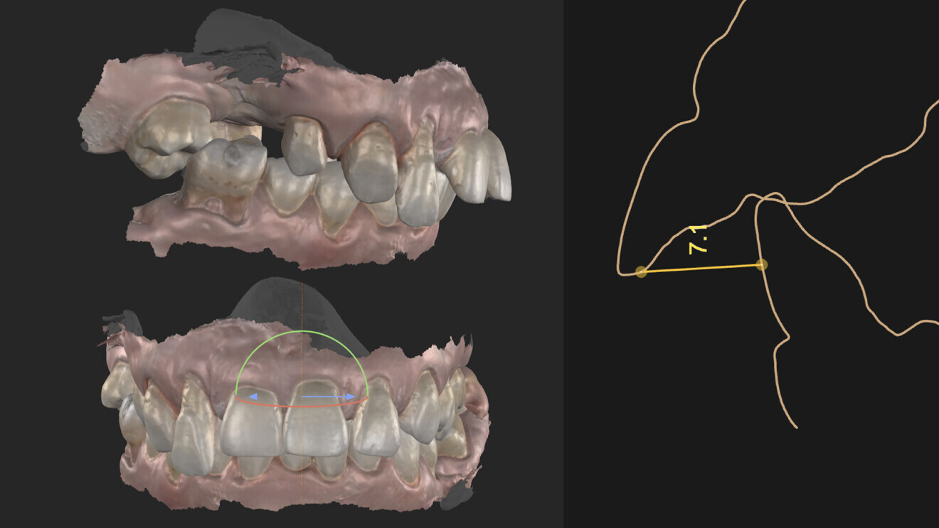 Fig. 3: Overjet and overbite.